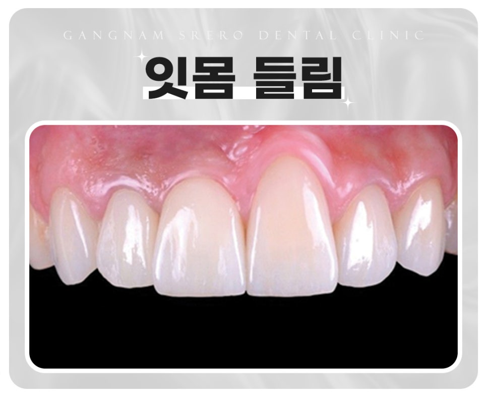 임플란트 부작용 자세히 알아보기(3) 임플란트 치주조직손상 부작용 [ 예방 및 대처 방법 ] [ 강남새로치과 ] 관련 이미지 3