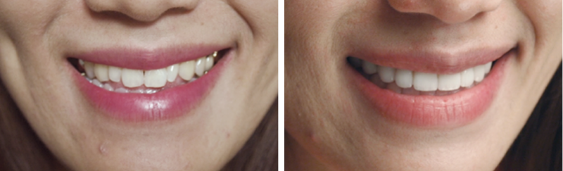 누런 앞니, 치아의 문제를 에어네이트 진료로 해결하려면 관련 이미지 3