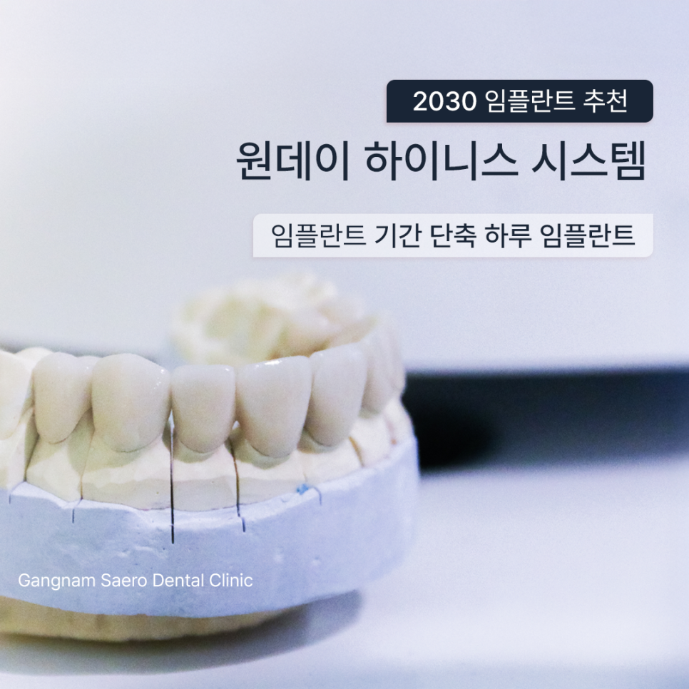 20대임플란트 30대임플란트, 임플란트기간 단축 하루임플란트 관련 이미지 1