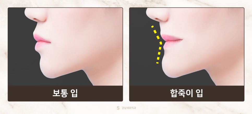 교정 부작용 총정리 [ 교정 부작용 예방법 ] [ 강남새로치과 ] 관련 이미지 4