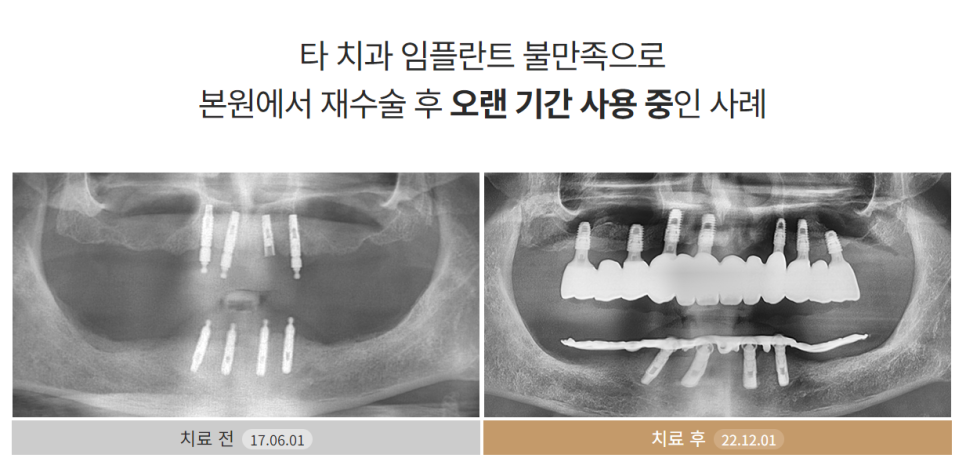 65세이상임플란트 (전체임플란트전후) 관련 이미지 7