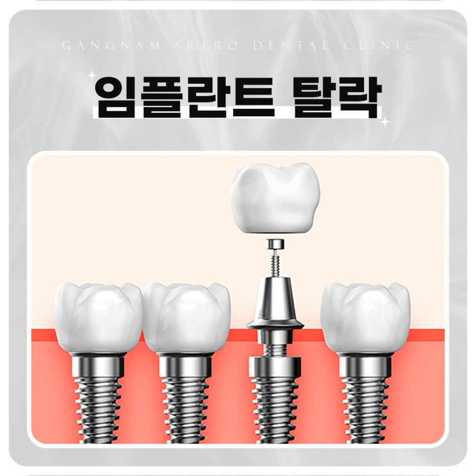 임플란트 부작용 자세히 알아보기(3) 임플란트 치주조직손상 부작용 [ 예방 및 대처 방법 ] [ 강남새로치과 ] 관련 이미지 2