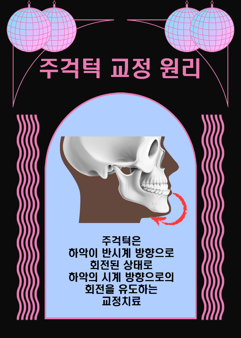 성인 주걱턱 수술 없이 비수술로 (성인 주걱턱교정) 관련 이미지 3