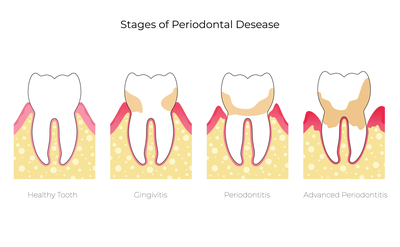 치아 변색 원인에 따른 치아미백효과 (치아미백비용) 관련 이미지 7