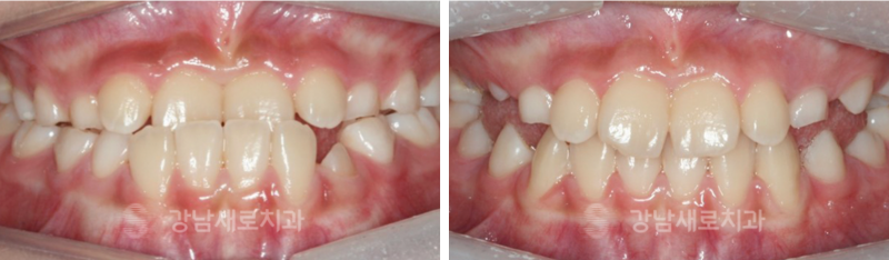 어린이주걱턱교정, 성장기전 빠른 시일내에 진행해야 하는 이유? 관련 이미지 4