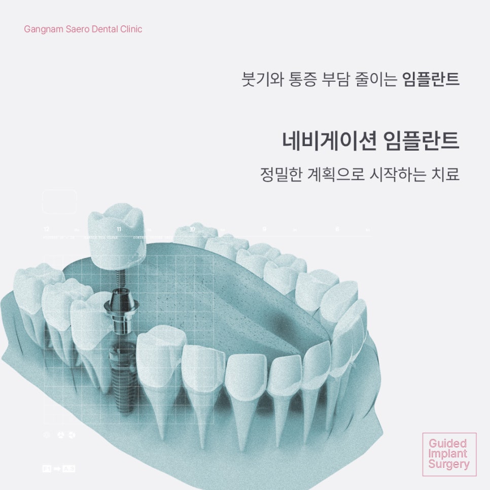 Implants with Less Swelling and Pain Burden (Navigation-Guided Implants) image 1