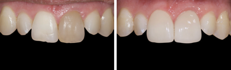 누런 앞니, 치아의 문제를 에어네이트 진료로 해결하려면 관련 이미지 2