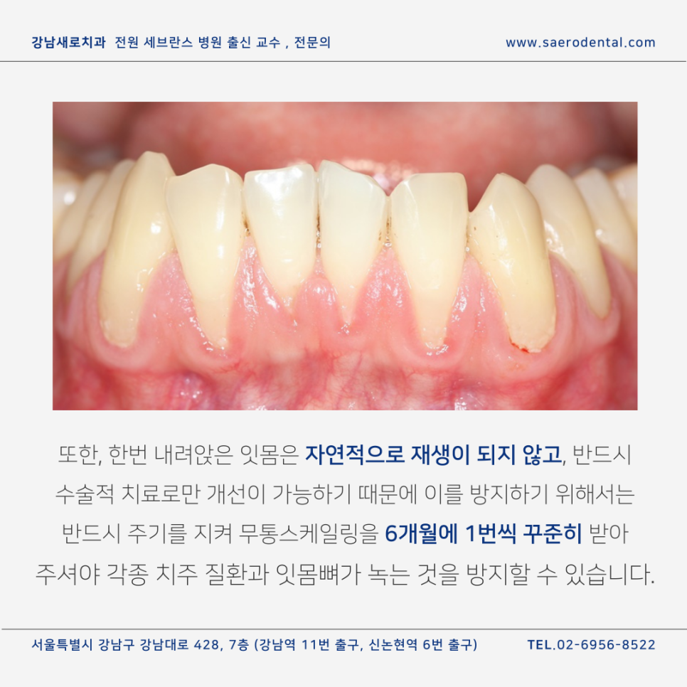 무통스케일링, 관련 이미지 6