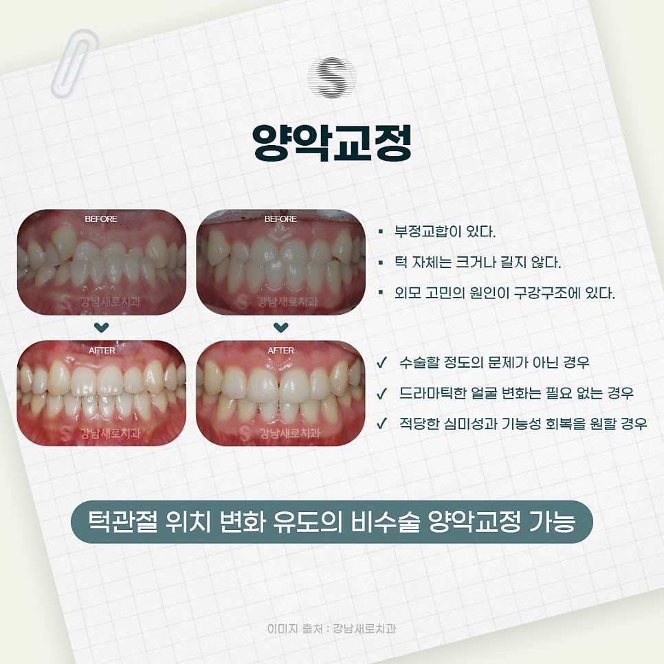 양악수술과 양악교정의 차이 (치과양악교정) 관련 이미지 4