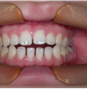 입 안 다물어짐 수술 없이 해결하는 방법 관련 이미지 6