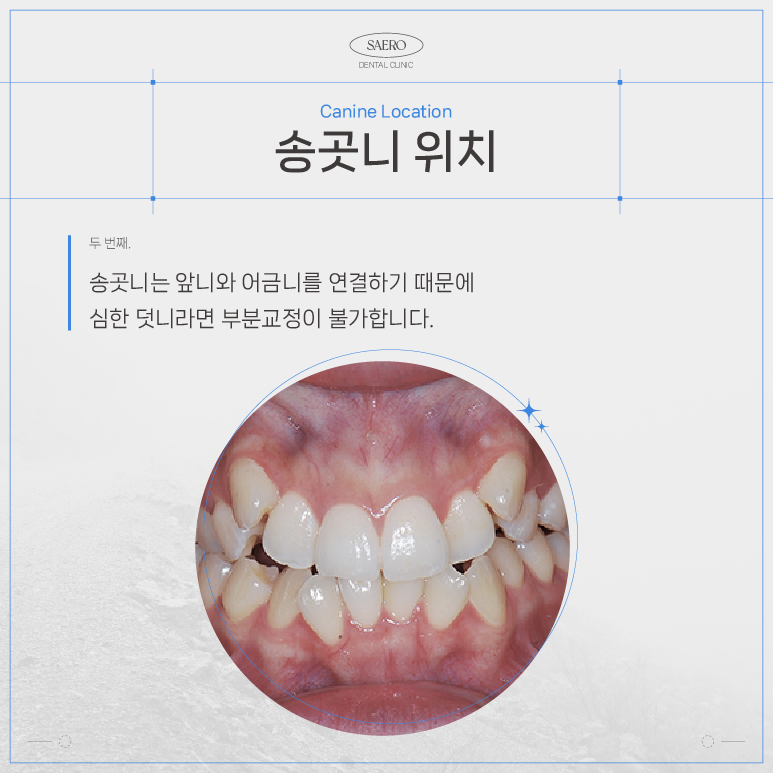 LPA MTA 부분교정 (앞니만 교정하고 싶을 땐 전체교정 대신 부분교정) [ 강남새로치과 ] 관련 이미지 4
