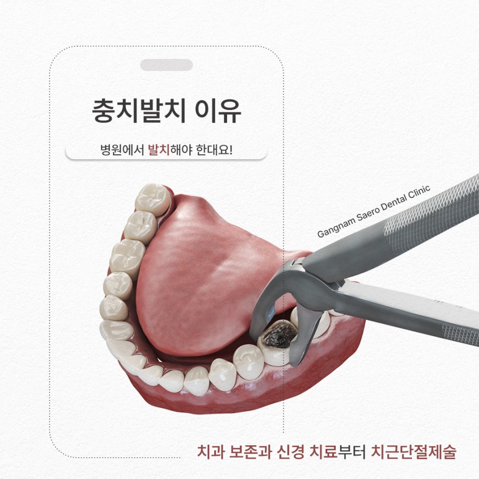 What If Your Dentist Says a Severely Decayed Tooth Needs to Be Extracted? (Reasons for Extraction Due to Tooth Decay) image 1