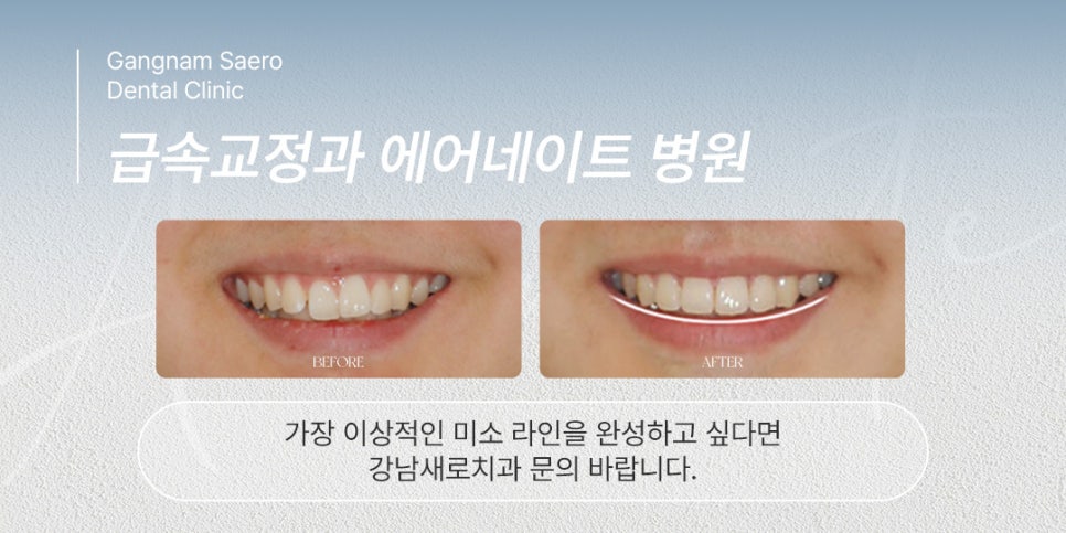 급속교정 과 삭제제로라미네이트 의 시너지 (교정라미네이트) 관련 이미지 6