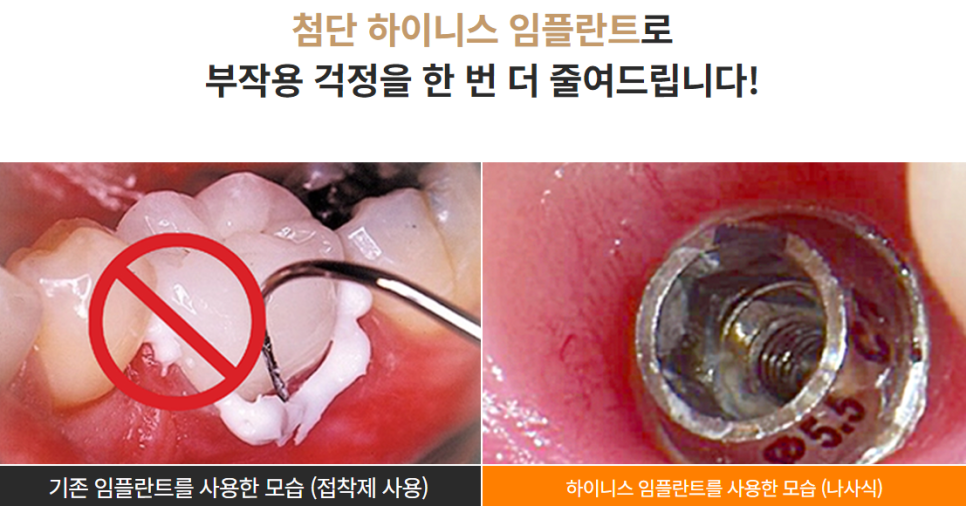 부작용 줄이는 임플란트 [ 네비게이션 임플란트 ] [ 강남새로치과 ] 관련 이미지 8