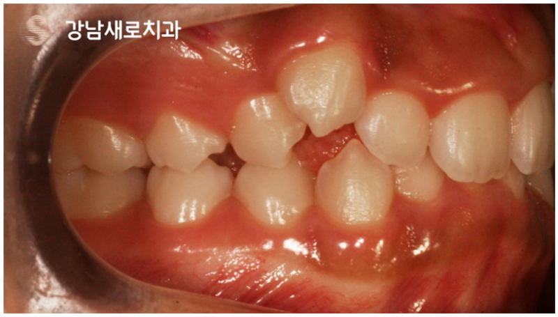 송곳니덧니교정을 발치 문제 없이 진행할 수 있다면? 관련 이미지 6