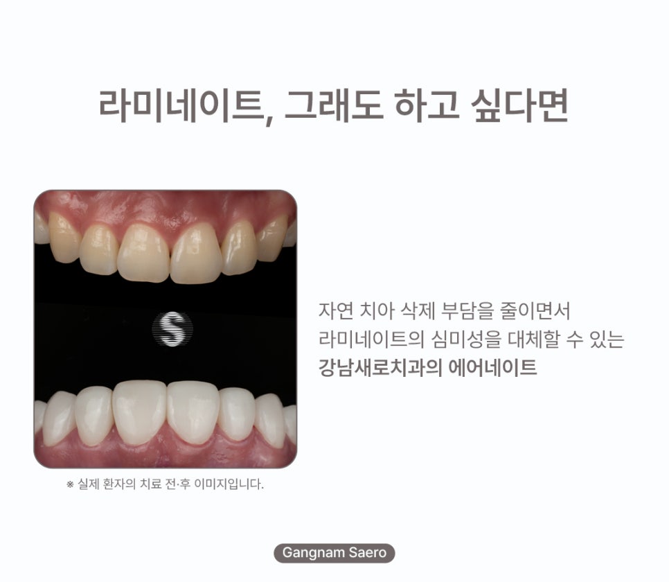 치아 삭제 부담을 줄인 심미 치료 (라미네이트대체 에어네이트) 관련 이미지 3