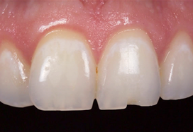 치아크랙 치아벌어짐 치아파절 회복하는 방법 (치아레진) 관련 이미지 3