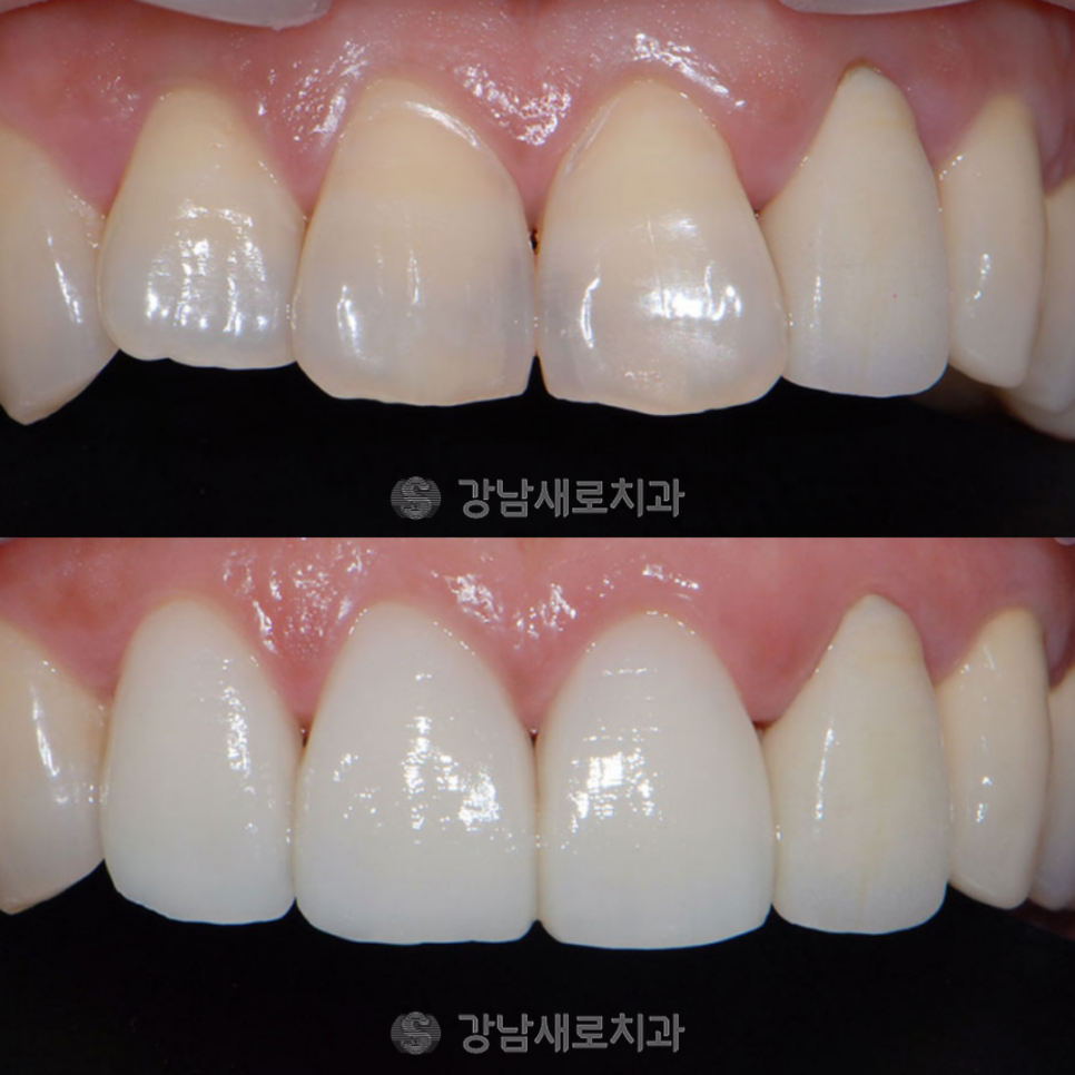 연예인라미네이트, 강남새로치과만의 특별한 방법? 관련 이미지 11