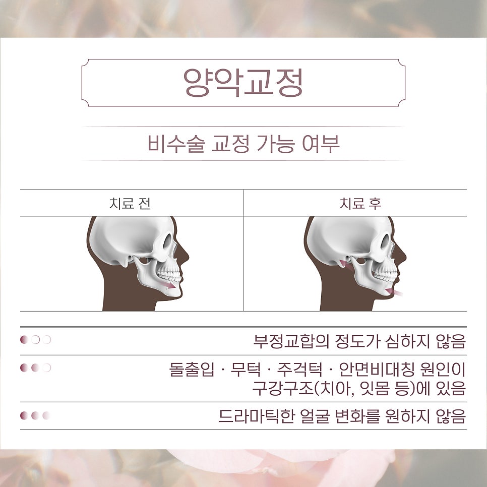(부정교합 / 앞니 / 잇몸) 비수술 치과성형 관련 이미지 3