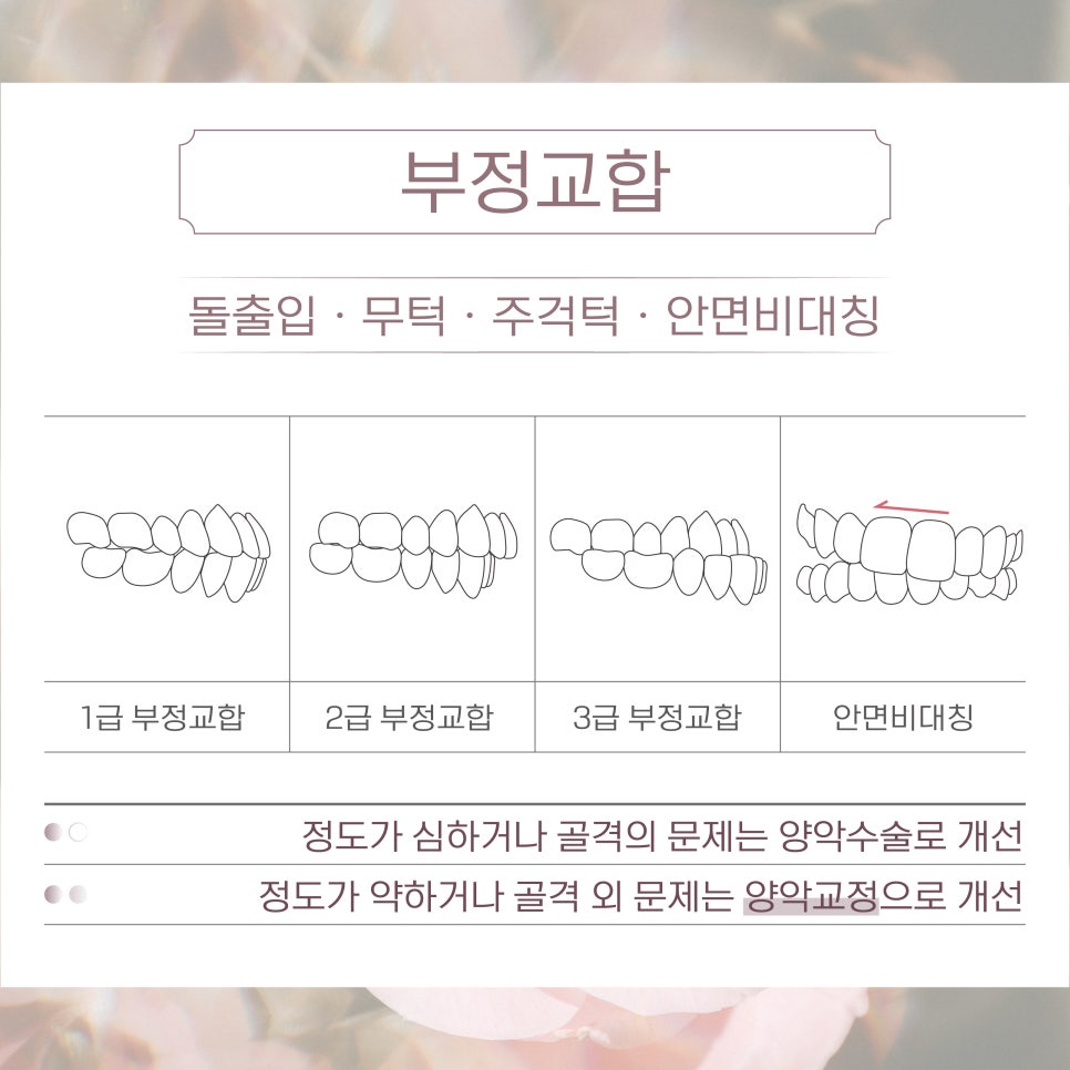외모 고민별 치과 진료 목록 (부정교합 앞니 잇몸) [ 강남새로치과 ] 관련 이미지 2