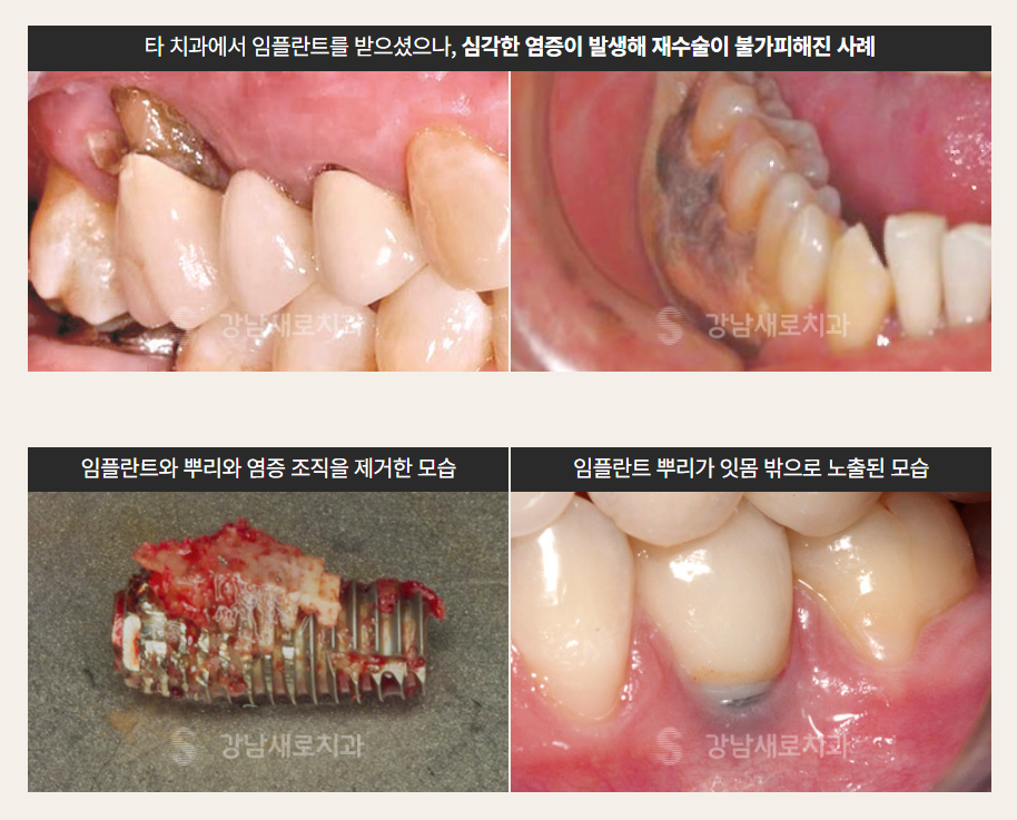 당뇨, 고혈압, 골다공증 대상 임플란트 안내 [ PRF 임플란트 ] [ 강남새로치과 ] 관련 이미지 1
