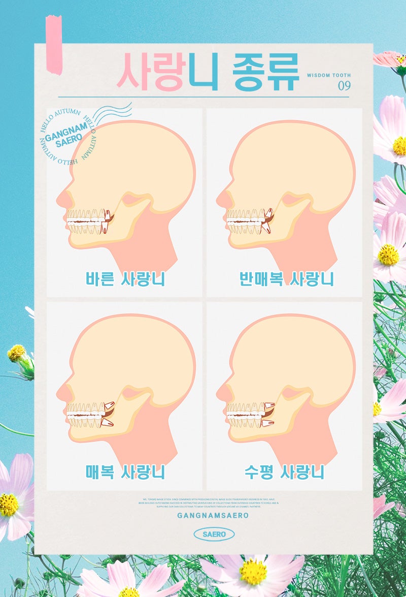 사랑니 오해와 진실 (사랑니발치) 관련 이미지 2