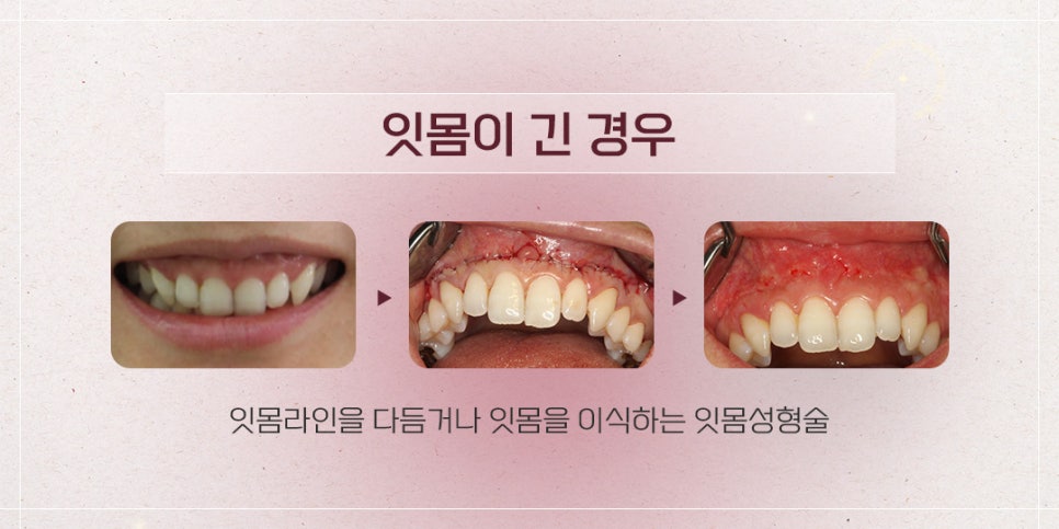 잇몸이 돌출되었을 때 해결방법 (잇몸돌출교정) 관련 이미지 4