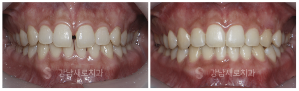 4개월만에 끝나는 부분교정 (급속교정후기) 관련 이미지 3