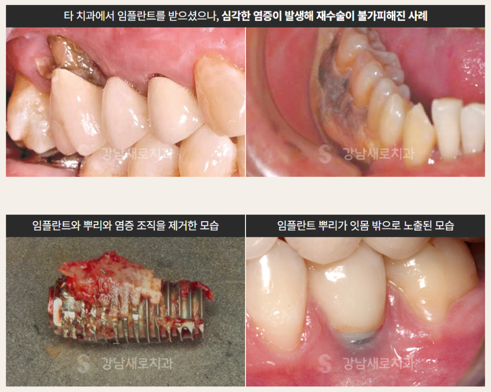 당뇨, 고혈압, 골다공증 환자 맞춤형 (PRF임플란트 자가혈임플란트) 관련 이미지 2