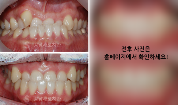 성인주걱턱 지금이라도 치료하려면 (성인비수술주걱턱) 관련 이미지 5