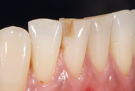 치아크랙 치아벌어짐 치아파절 회복하는 방법 (치아레진) 관련 이미지 5