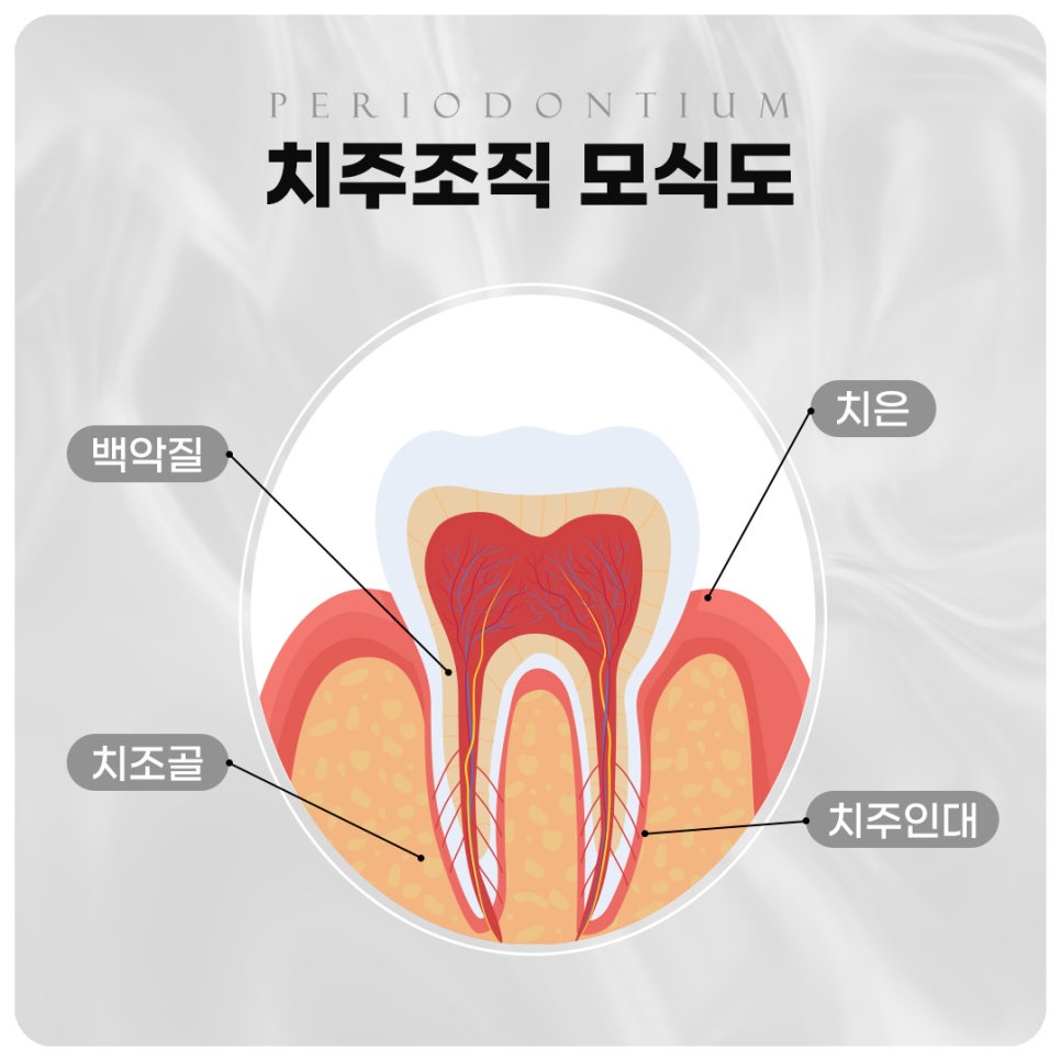 임플란트 부작용 자세히 알아보기(3) 임플란트 치주조직손상 부작용 [ 예방 및 대처 방법 ] [ 강남새로치과 ] 관련 이미지 1