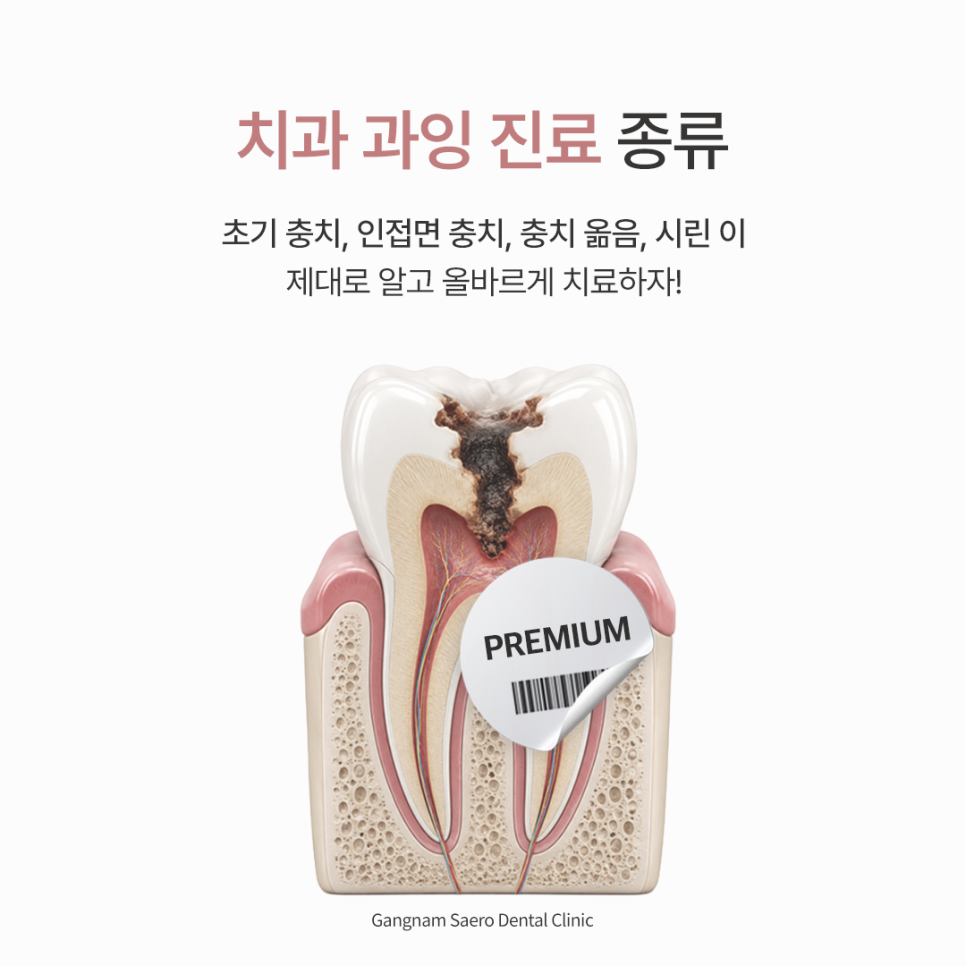 치과과잉진료 종류, 초기충치 인접면충치 충치옮음 시린이 제대로 알고 올바르게 치료하자 관련 이미지 1