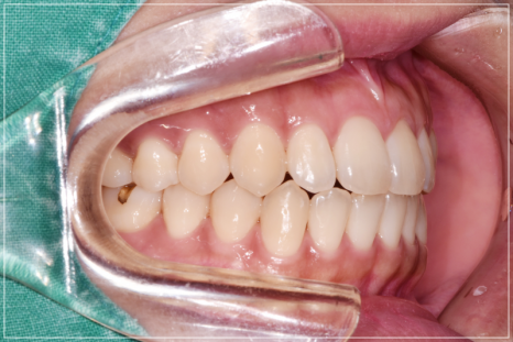 입안다물어짐 비수술로 해결이 가능하다면 관련 이미지 13