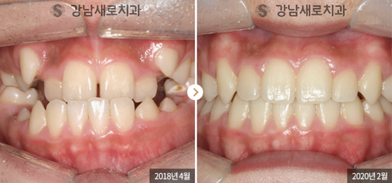 송곳니덧니교정, 방치하면 부작용이 발생한다? 관련 이미지 4
