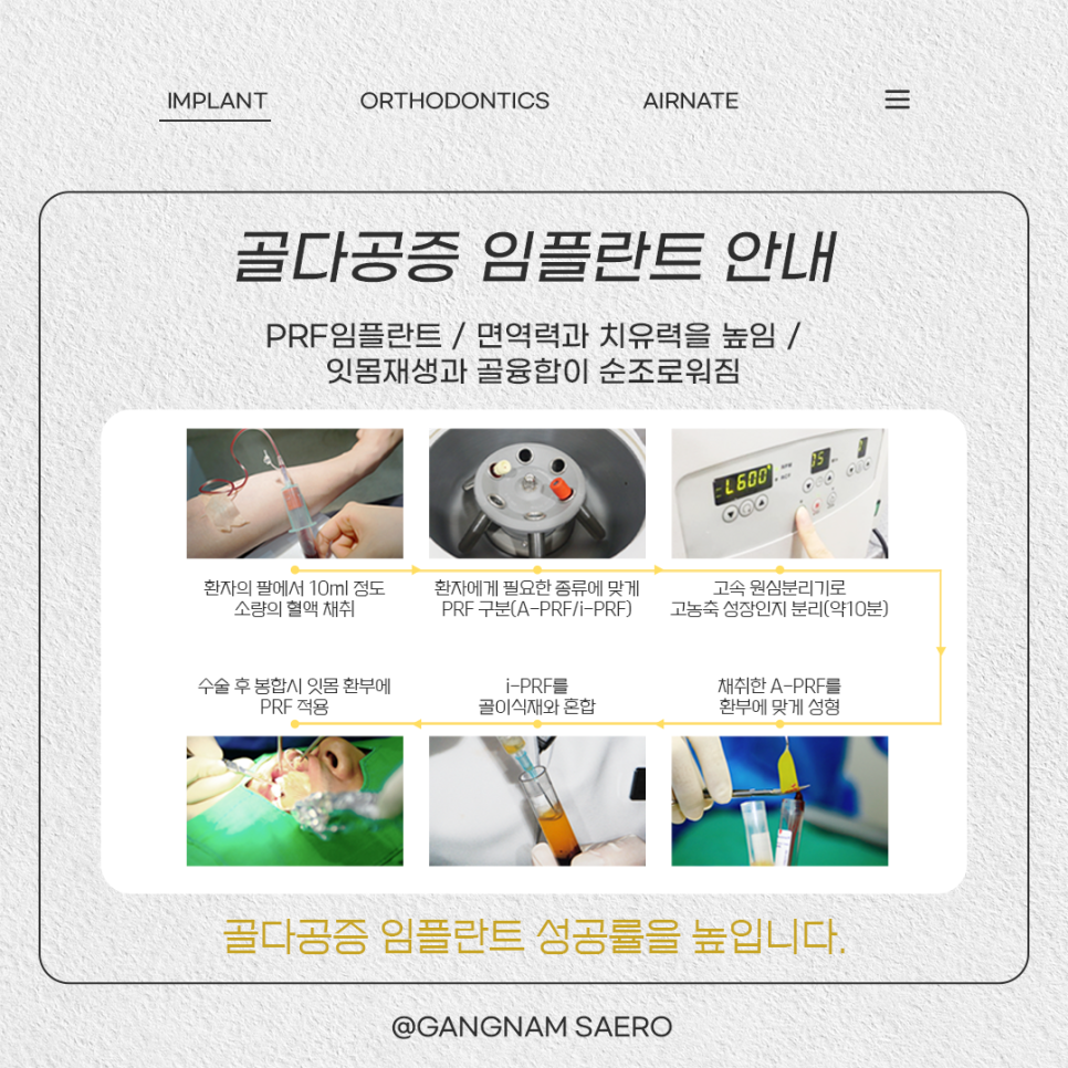 골다공증 증상과 원인 골다공증임플란트 (PRF임플란트) 관련 이미지 5