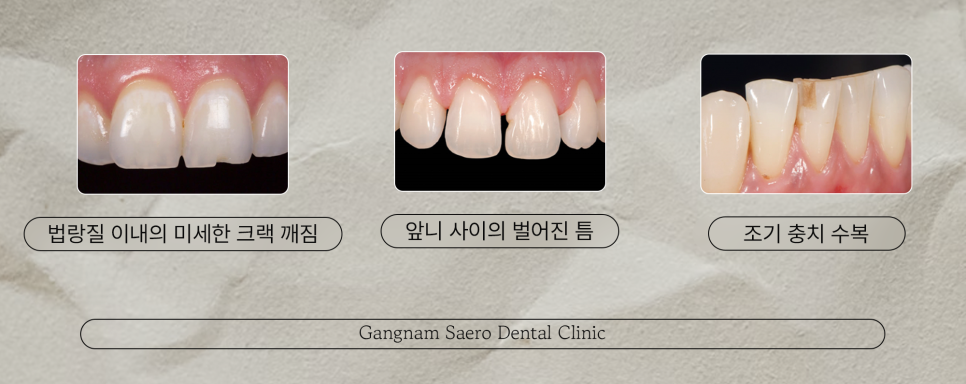 (치아레진 으로 치료하는) 치아크랙 치아깨짐 치아벌어짐 치아파절 치아모양 관련 이미지 4
