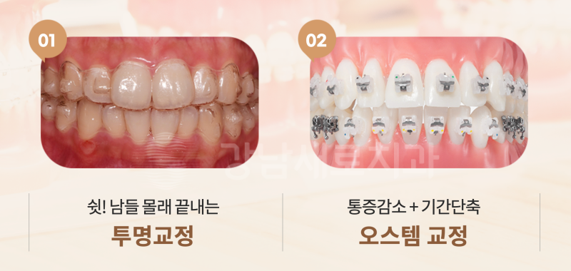강남역교정치과를 찾고 계신다면? 비발치로 해결하세요! 관련 이미지 3