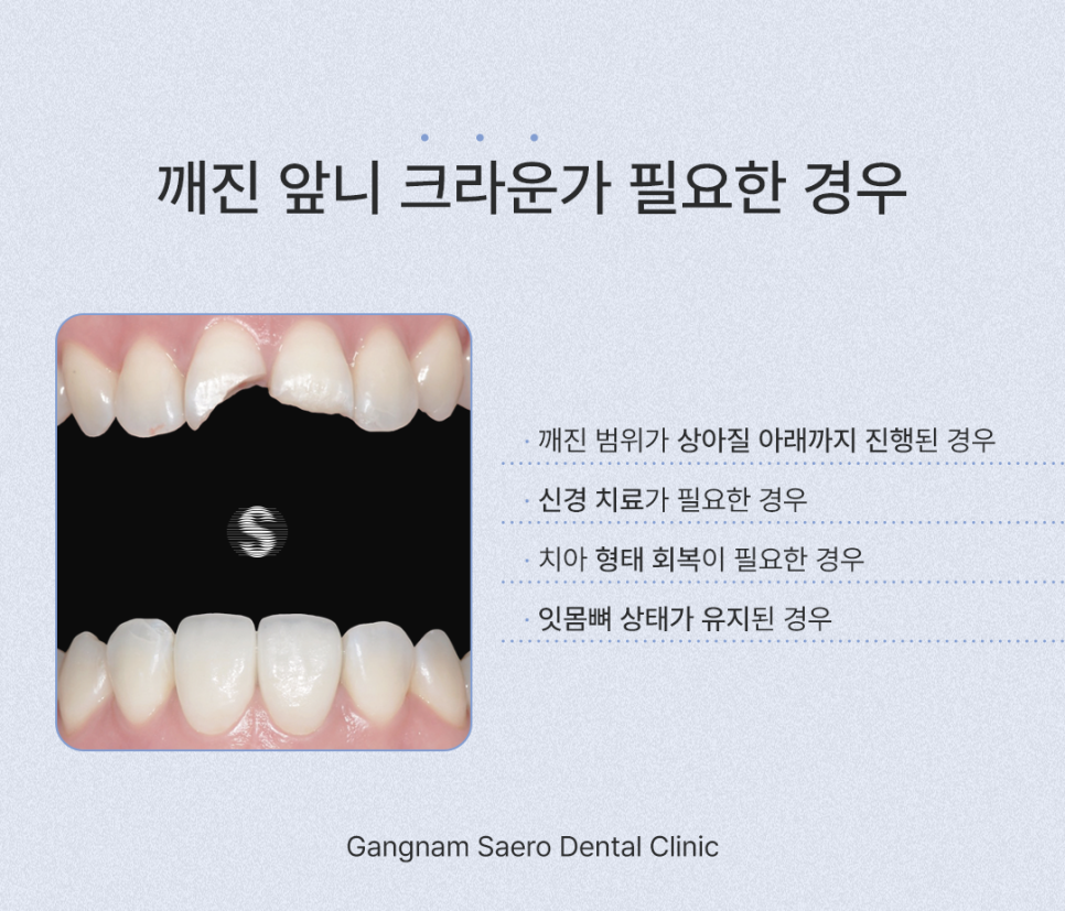앞니깨졌을때, 깨진앞니 치료하는 여러 가지 방법 레진 / 라미네이트 / 크라운 / 임플란트 관련 이미지 6