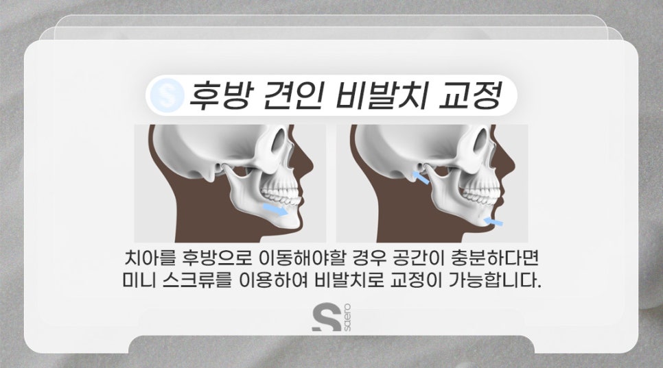 치아교정할 때 발치해야 하는 이유 (비발치중심 치아교정) 관련 이미지 6