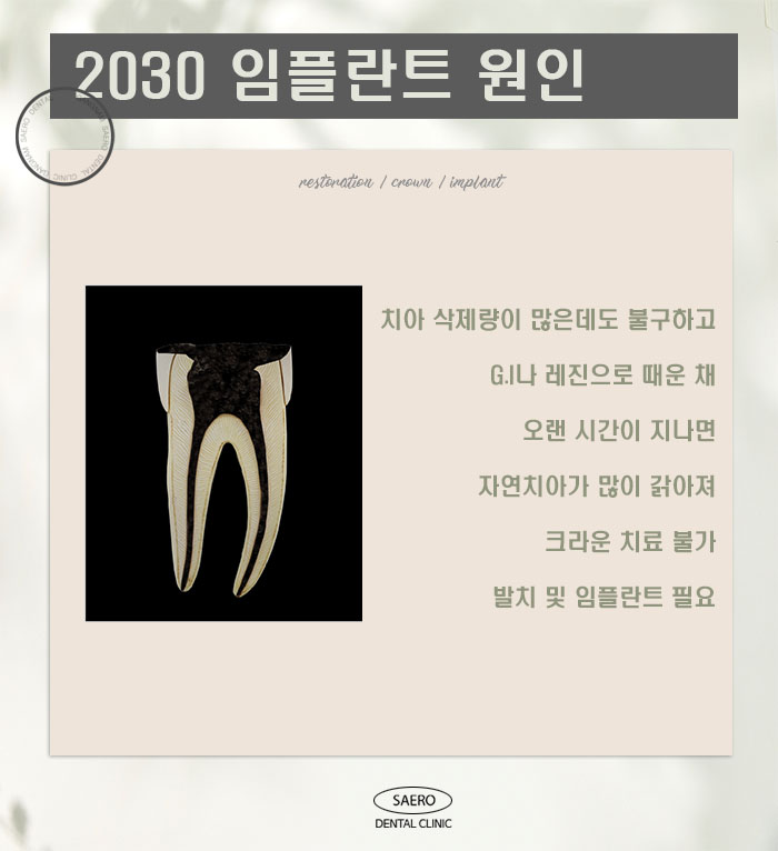 충치치료 치아때우기와 치아씌우기 (20대임플란트 30대임플란트) 관련 이미지 3