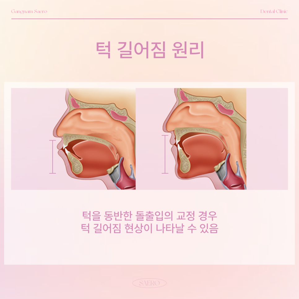 교정얼굴변화 부작용 안내 (옥니, 팔자주름, 인중 길어짐 등) 관련 이미지 4