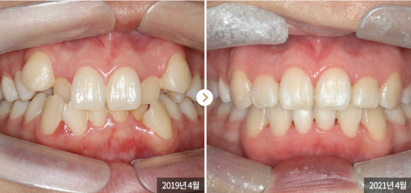 송곳니덧니교정을 발치 문제 없이 진행할 수 있다면? 관련 이미지 3