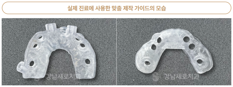 임플란트붓기 출혈 통증 걱정된다면 (네비게이션 임플란트) 관련 이미지 5