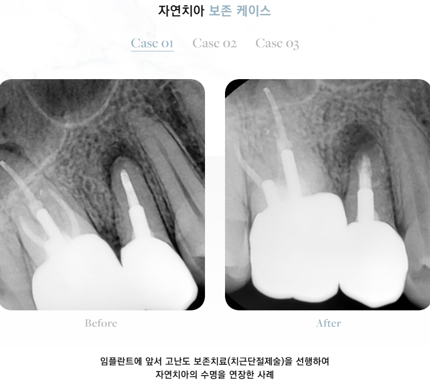 임플란트수술 단순히 심는 줄로만 알았다면 확인해 봐야 할 (임플란트수술) 관련 이미지 5