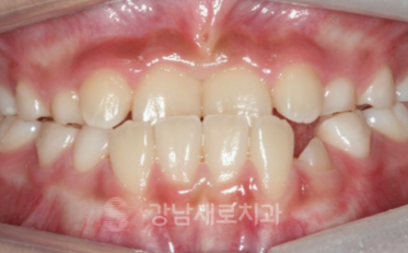 유아 주걱턱교정, 올바른 뼈 성장을 위한 방법 관련 이미지 8