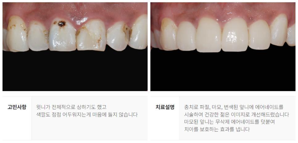 강남역 라미네이트대체 시술 (에어네이트) 관련 이미지 11