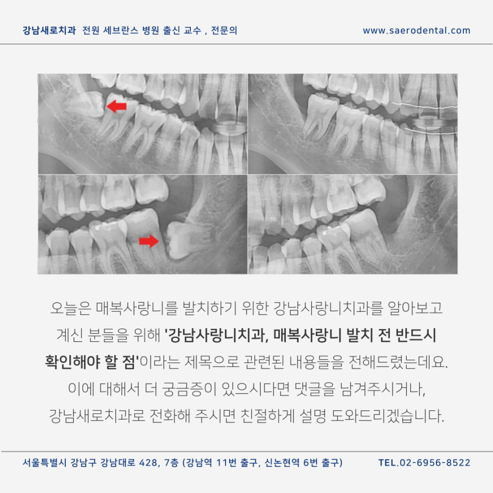 강남사랑니치과, 매복사랑니를 더욱 효율적으로 발치하려면 관련 이미지 12