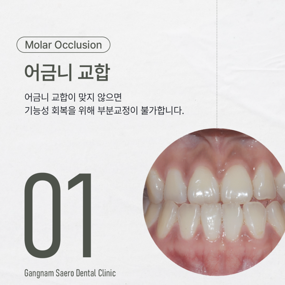 앞니만 교정하고 싶다면 부분만 교정하는 (앞니교정) 관련 이미지 2