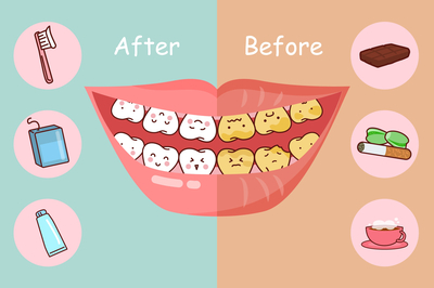 치아 변색 원인에 따른 치아미백효과 (치아미백비용) 관련 이미지 5